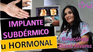 IMPLANTE SUBDERMICO U HORMONAL POR GINECOLOGA DIANA ALVAREZ [upl. by Llovera831]