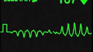 Torsades de Pointes  ECG Simulator  Arrhythmia Simulator [upl. by Ihn]