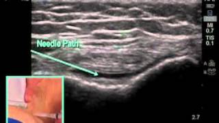 How to Ultrasound Guided Knee Injection Scanning Technique [upl. by Sirap]