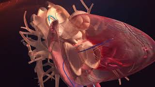 Opération cardiaque en 3D  Cathéter cardiaque [upl. by Selmore]