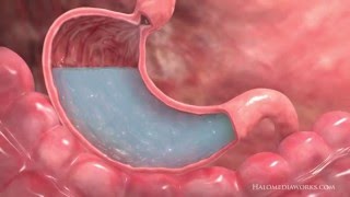 Gastric Sleeve 3D Explained Canada [upl. by Novar955]