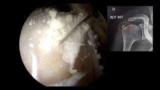 EPAULE N°3  Calcification [upl. by Yahsal60]