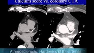 UCSF Radiology Calcium Scoring vs Coronary CTA Scan [upl. by Yrred933]