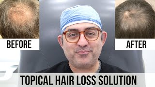 Topical Finasteride and Minoxidil HAIR LOSS Solution [upl. by Ayalat]