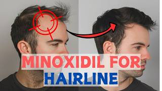 Minoxidil for Frontal Baldness  Restore Your Hairline [upl. by Solrac]