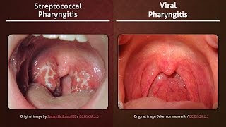 Streptococcal vs Viral Pharyngitis [upl. by Joeann794]