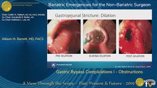 Gastric Bypass Complications I  Obstructions [upl. by Nivrem]