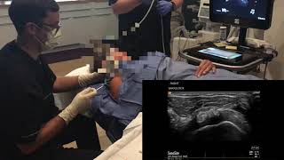 Ultrasound guided aspiration and lavage of calcific tendinitis [upl. by Llenrad]