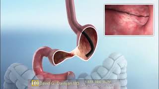 Laparoscopic Gastric Bypass Animation [upl. by Widera]