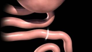 Gastric Sleeve Revision Surgery Animation [upl. by Nnyleitak952]