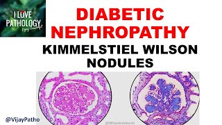 DIABETIC NEPHROPATHY Pathophysiology amp Morphology [upl. by Glenden]