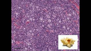 Histopathology  Nodular Lymphocyte Predominant Hodgkin Lymphoma [upl. by Carlstrom]