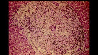 Key Biliary Tract  Cholestatic Diseases amp Labs Explained [upl. by Templa]