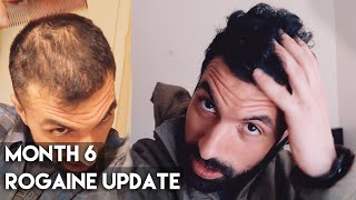 6 Month Rogaine Results Minoxidil [upl. by Daj]