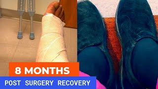 Haglund’s Deformity Surgery Recovery Update 8 months later [upl. by Shulem]