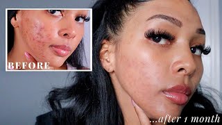 SPIRONOLACTONE CHANGED MY SKIN UPDATE AFTER 1 MONTH  NEW JOURNEY TO CLEAR SKIN PT 5 [upl. by Nosreip]