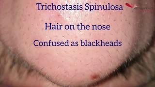 Hair removal on the nose by Laser  Trichostasis Spinulosa [upl. by Githens]