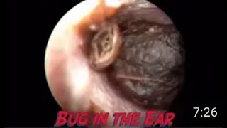 Insect inside the ear [upl. by Lednik733]