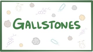 Gallstones cholelithiasis [upl. by Reivaxe]