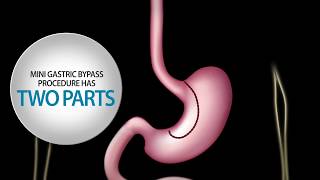 Gastric Sleeve Procedure Sleeve Gastrectomy [upl. by Garda]