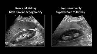 Primary Biliary cirrhosis Lecture [upl. by Maryjo]