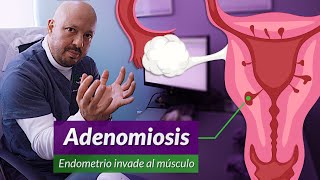 Cirugía por Adenomiosis Y diferencia con miomas y endometriosis [upl. by Tifanie]