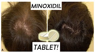 Minoxidil Tablets replacement for 5 MinoxPros amp Cons Episode 1 [upl. by Giorgio]