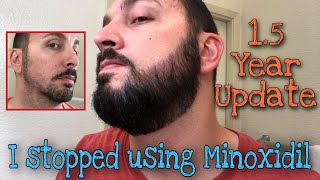 I Stopped Using Minoxidil on my Beard and 15 Year Update 18 Months [upl. by Clarhe]