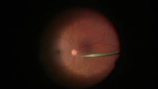 Endolaser Panretinal Photocoagulation PRP [upl. by Marchall704]