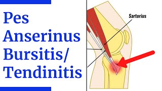 Pes Anserine BursitisTendinitis Evaluation [upl. by Moore136]