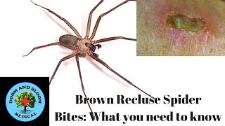 Brown Recluse Spider Bites What you need to know [upl. by Darees]