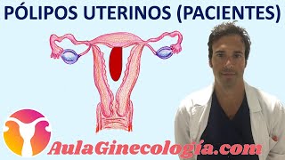 PÓLIPOS UTERINOS PACIENTES Síntomas diagnóstico y tratamiento  Ginecología y Obstetricia [upl. by Icram527]