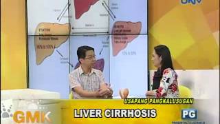 Understanding Liver Cirrhosis [upl. by Fishback]