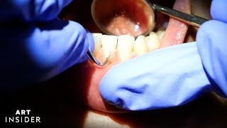 How Buildup Is Satisfyingly Removed From Teeth [upl. by Neih416]