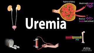 Uremia Pathophysiology Symptoms Diagnosis and Treatment Animation [upl. by Naig936]