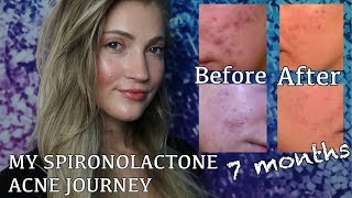 SPIRONOLACTONE FOR HORMONAL ACNE BEFORE  AFTER PICTURES MY EXPERIENCE AND WHY I STOPPED TAKING IT [upl. by Pachston]