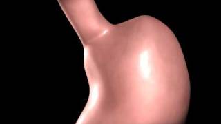 Roux en Y gastric bypass animation [upl. by Leahcimauhsoj]