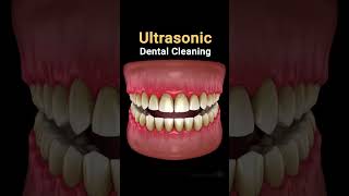 Ultrasonic dental cleaning [upl. by Nielsen]