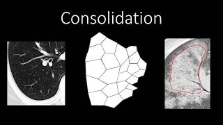 Chest Radiology  Patterns  Airspace [upl. by Amend178]