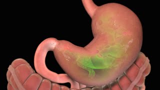 Stomach Ulcer  Nucleus Health [upl. by Ibbie]