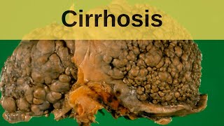 Histopathology LiverPrimary biliary cirrhosis [upl. by Zina]