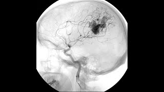 Neuro Surgical Procedure Using Stereotaxic Apparatus  Dr Shamsher Singh [upl. by Elgna]