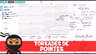 Rate and Rhythm  Torsades de Pointes [upl. by Halley468]