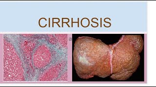 Cirrhosis [upl. by Origra]