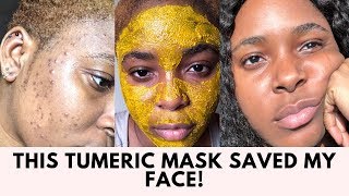 THE TUMERIC MASK THAT CLEARED MY ACNE SCARS AND HYPER PIGMENTATION [upl. by Bonns]