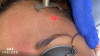 Minimize Acne Scarring With Laser Resurfacing [upl. by Notnef]