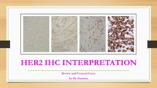 HER2 IHC Interpretation Guide Examples and Challenging Scenarios [upl. by Lucchesi]