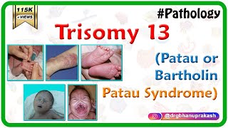 Trisomy 13 Patau or BartholinPatau syndrome  Causes  Diagnosis  Treatment [upl. by Ennovyahs]