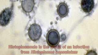 Histoplasma capsulatum amp Histoplasmosis [upl. by Bred]